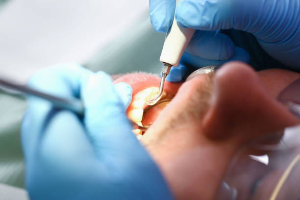 Best Emergency Dental Care for Abscessed Tooth in Lagunitas Forest Knolls, CA